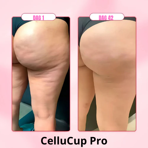 CelluCup Pro Cellulitis Verlosser